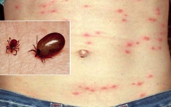 बैतडीमा स्क्रब टाइफसका बिरामी बढ्दै, १२६ जनामा संक्रमण पुष्टि 